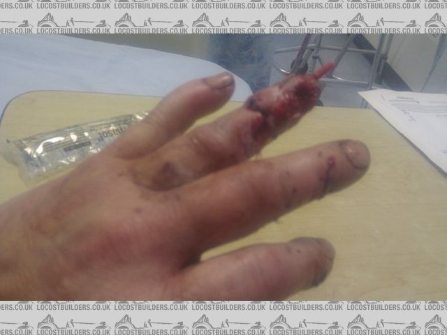 My finger after surgery